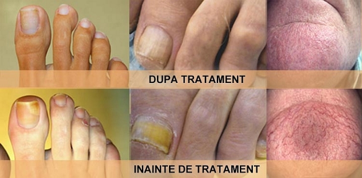 tratament cu laser pentru ciuperca unghiilor si picioarelor